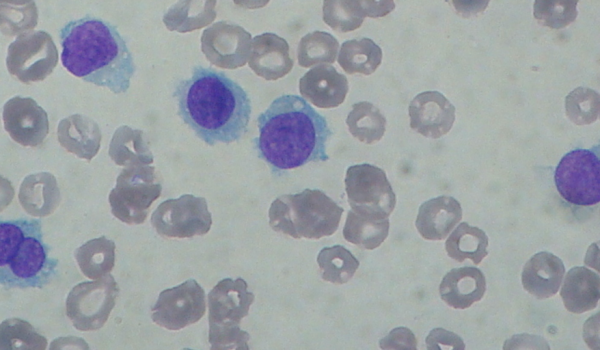 Hairy Cell Leukaemia