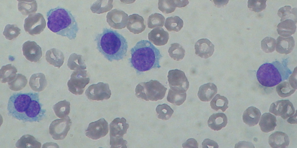 Hairy Cell Leukaemia